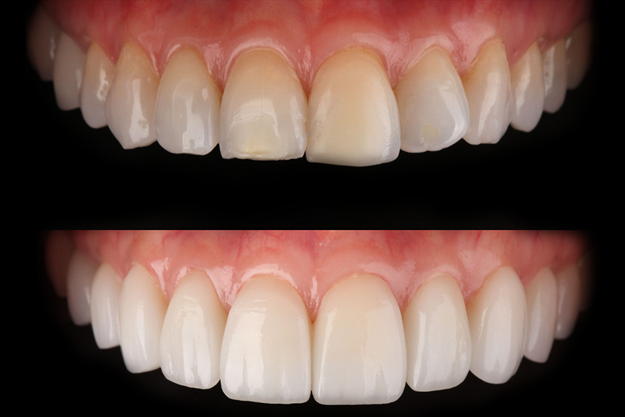 Porcelain-veneer