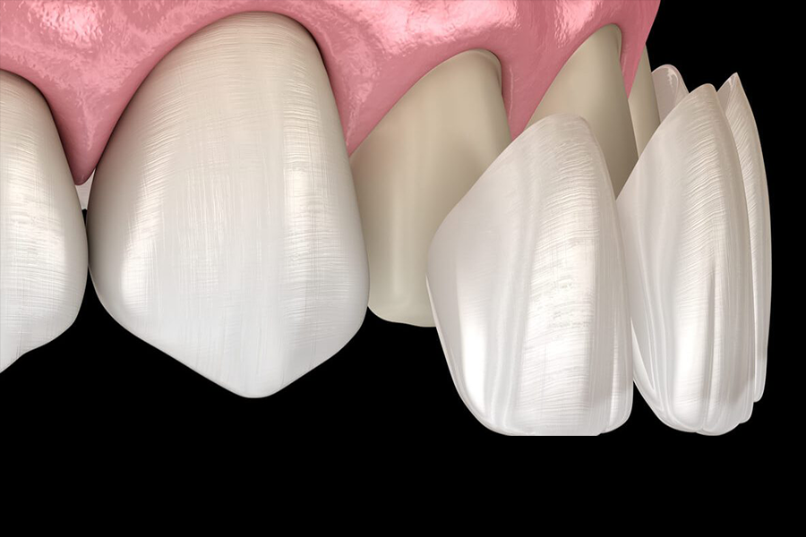 composite-veneers