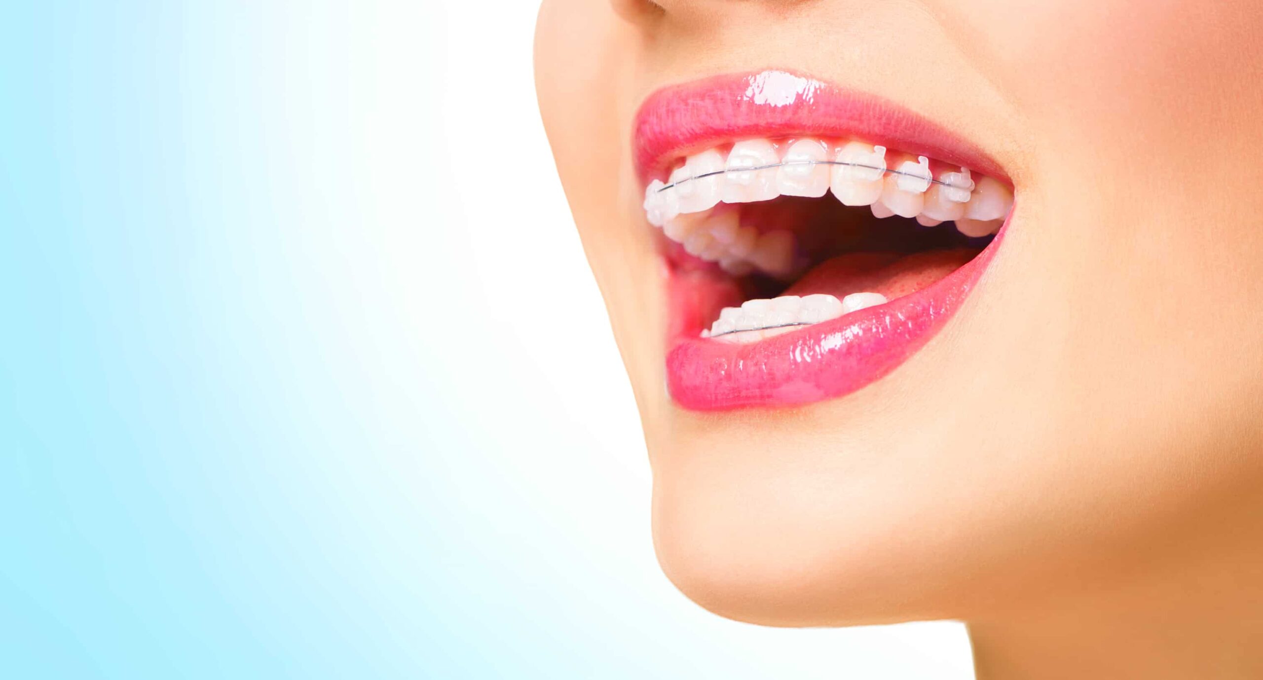 2 ceramic-braces-barrhaven-ottawa