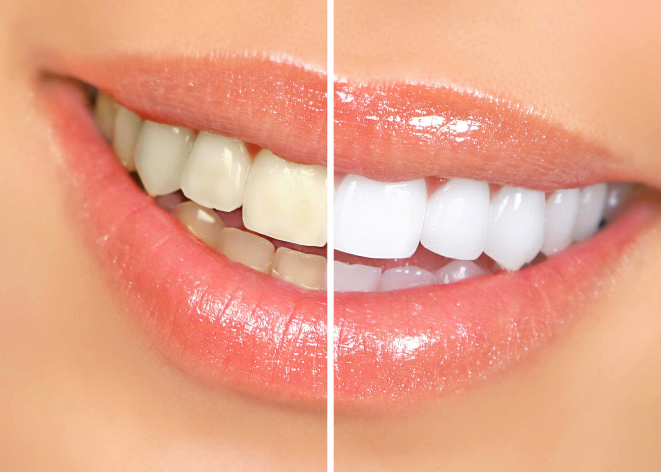teeth-whitening VNATRE